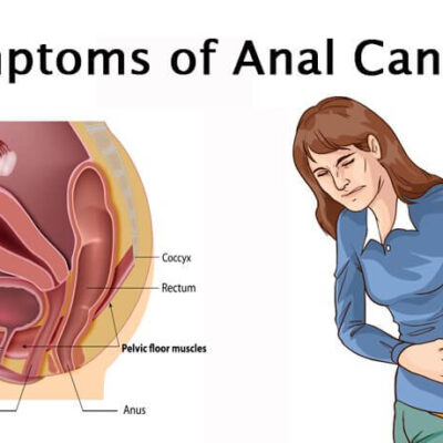 Anal Cancer Discharge of blood or pus from the anus. Anal Cancer Discharge of blood or pus from the anus.